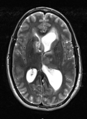 2A3 HGAP (Case 2) T2W - Copy
