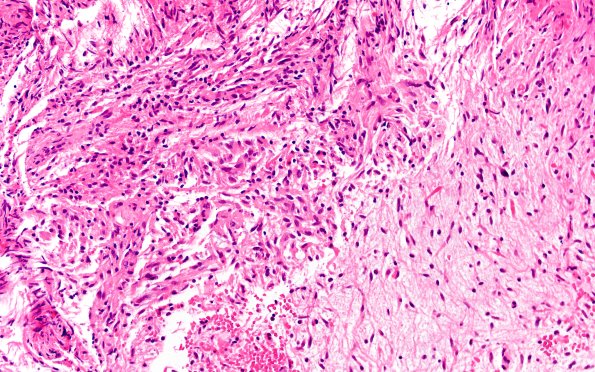 2B1 HGAP (Case 2) H&E 20X 1