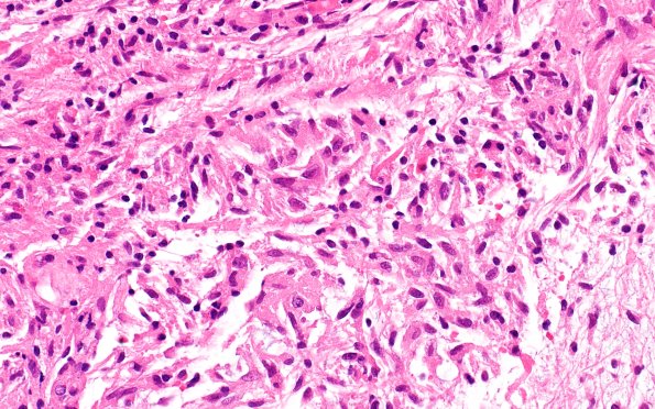 2B2 HGAP (Case 2) H&E 40X 1