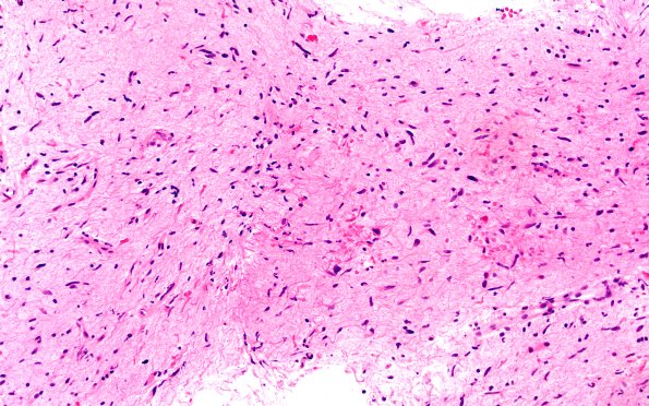 2B3 HGAP (Case 2) H&E 20X 2