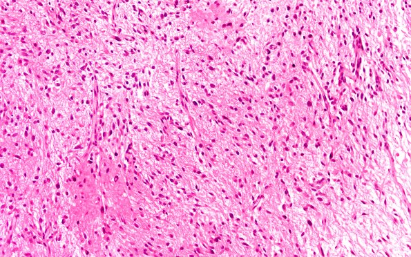 2B5 HGAP (Case 2) H&E 20X 5