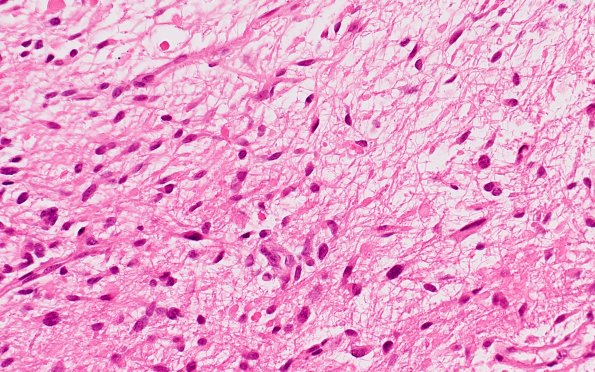 2B6 HGAP (Case 2) H&E 40X 5