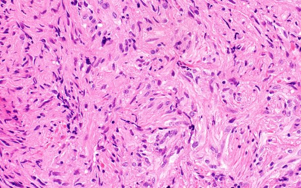 2B7 HGAP (Case 2) H&E 40X 4