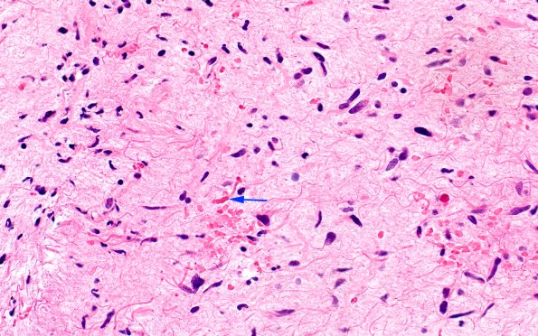 2B8 HGAP (Case 2) H&E 40X 2 copy