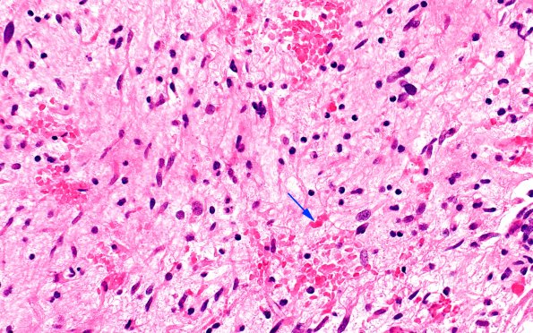 2B9 HGAP (Case 2) H&E 40X 6 copy