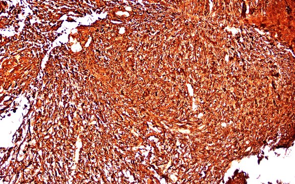 2C1 HGAP (Case 2) GFAP 20X 2A