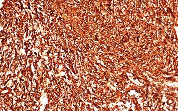 2C2 HGAP (Case 2) GFAP 20X 1