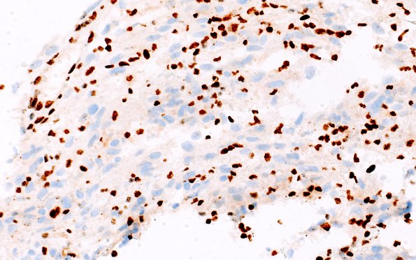 2D1 HGAP (Case 2) ATRX 40X 14