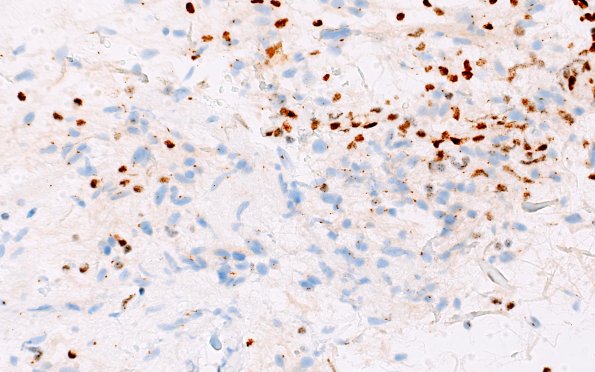 2D2 HGAP (Case 2) ATRX 40X 2