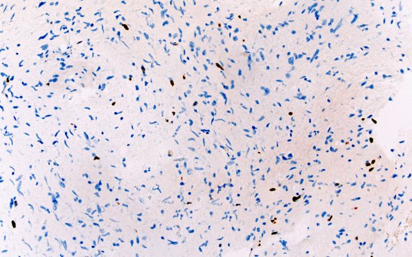 2E HGAP (Case 2) Ki67 20X