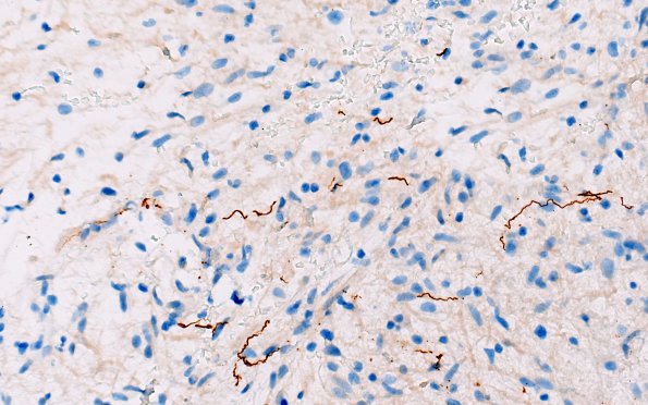 2F HGAP (Case 2) NF 40X