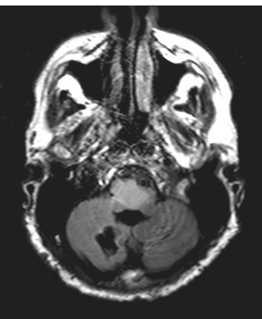 3A1 HGAP (Case 3) FLAIR - Copy