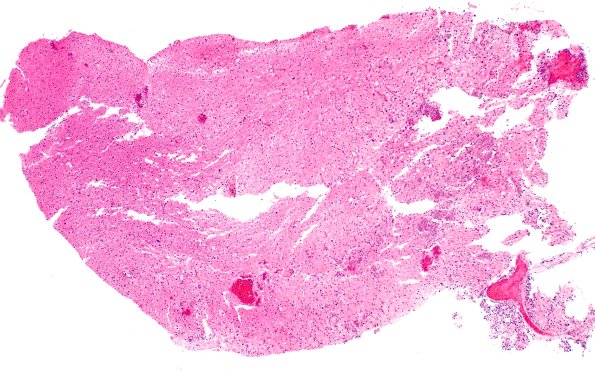 3B1 HGAP (Case 3) H&E 4X