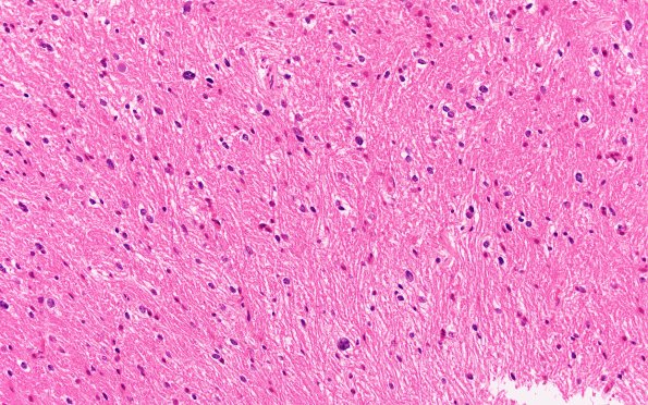 3B2 HGAP (Case 3) H&E 20X