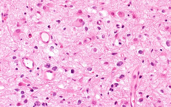 3B3 HGAP (Case 3) H&E 40X 2