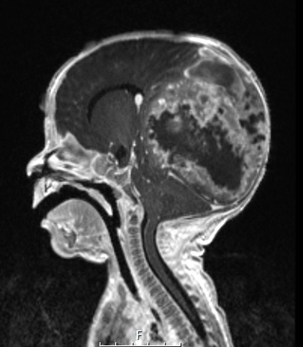 1A1 Infant-Type Hemispheric Glioma (Case 1) T1W sagittal - Copy