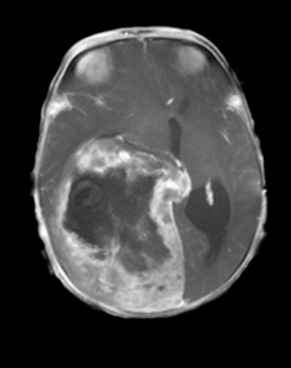 1A2 Infant-Type Hemispheric Glioma (Case 1) T1W axial - Copy