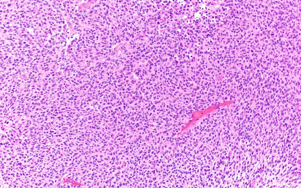 1B1 Infant-Type Hemispheric Glioma NTRK Altered (Case 1) H&E 20X 2