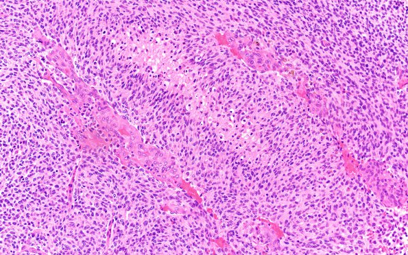 1B2 Infant-Type Hemispheric Glioma NTRK Altered (Case 1) H&E 20X