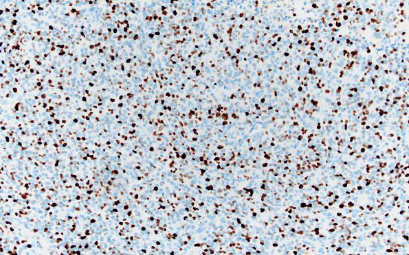 1F Infant-Type Hemispheric Glioma NTRK Altered (Case 1) Ki67 20X