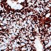 2C2 Inf Hemisp Glioma (Case 2) GFAP 40X