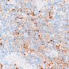 2F2 Inf Hemisp Glioma (Case 2) SYN 40X 3