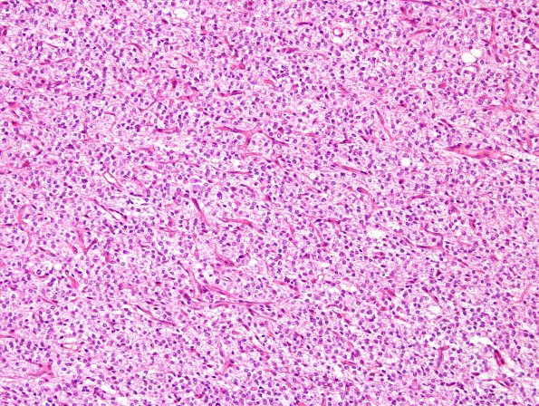 10A1 Oligodendroglioma (Case 10) H&E 7