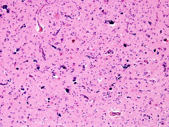 10A2 Oligodendroglioma (Case 10) H&E 5