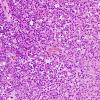 11A1 Oligodendroglioma WHO-III (Case 11) minigemistocytes H&E 1