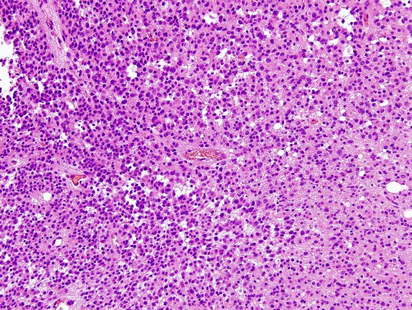 11A1 Oligodendroglioma WHO-III (Case 11) minigemistocytes H&E 1