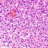 11A2 Oligodendroglioma WHO-III (Case 11) minigemistocytes H&E 3