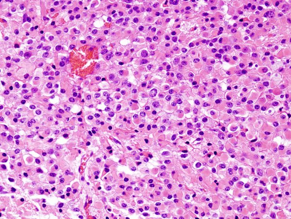 11A2 Oligodendroglioma WHO-III (Case 11) minigemistocytes H&E 3