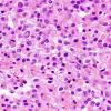 11A3 Oligodendroglioma WHO-III (Case 11) minigemistocytes H&E 4