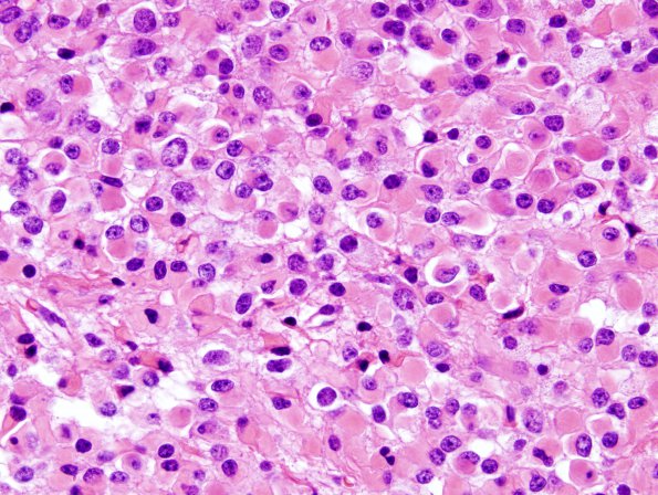 11A3 Oligodendroglioma WHO-III (Case 11) minigemistocytes H&E 4