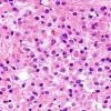 11A4 Oligodendroglioma WHO-III (Case 11) minigemistocytes H&E 6