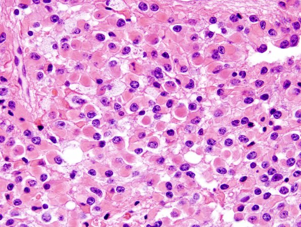 11A4 Oligodendroglioma WHO-III (Case 11) minigemistocytes H&E 6