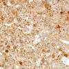 11B Oligodendroglioma WHO-III (Case 11) IDH1 1