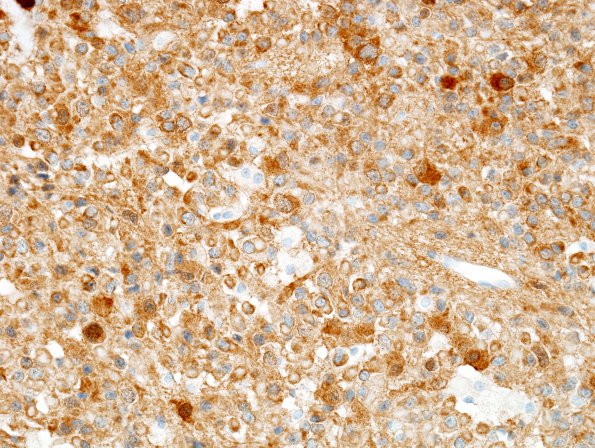 11B Oligodendroglioma WHO-III (Case 11) IDH1 1