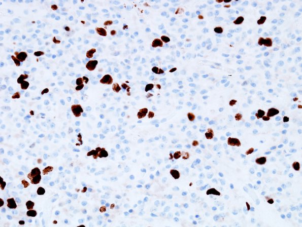 11C Oligodendroglioma WHO-III (Case 11) MIB 1