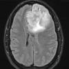 12A Oligodendroglioma, anaplastic (Case 12) FLAIR - Copy