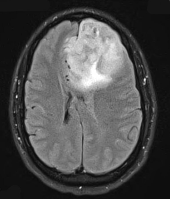 12A Oligodendroglioma, anaplastic (Case 12) FLAIR - Copy