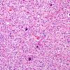 12B1 Oligodendroglioma, anaplastic (Case 12) H&E 3