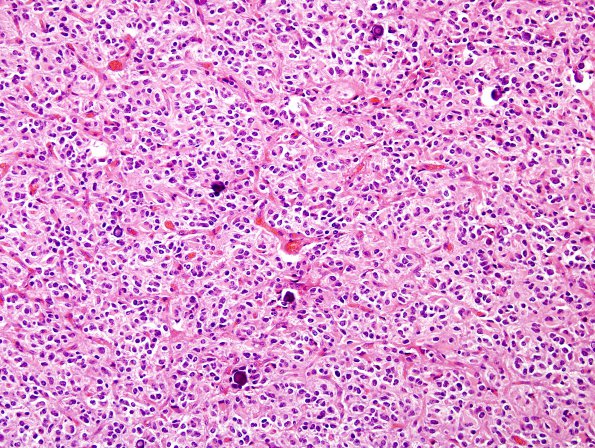 12B1 Oligodendroglioma, anaplastic (Case 12) H&E 3