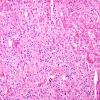 12B2 Oligodendroglioma, anaplastic (Case 12) H&E 6