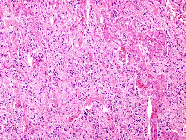 12B2 Oligodendroglioma, anaplastic (Case 12) H&E 6