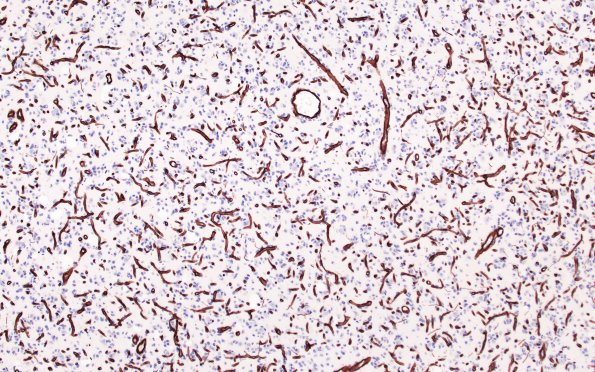 13A2 (Case 13) Oligo Coll IV 10X