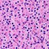 14A Oligodendroglioma, Minigemistocytes (Case 14A)