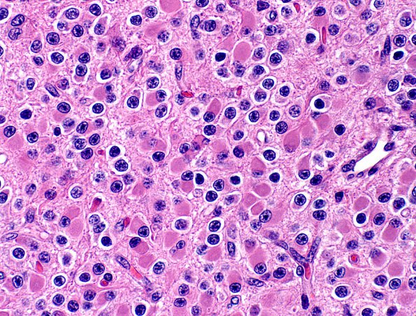 14A Oligodendroglioma, Minigemistocytes (Case 14A)