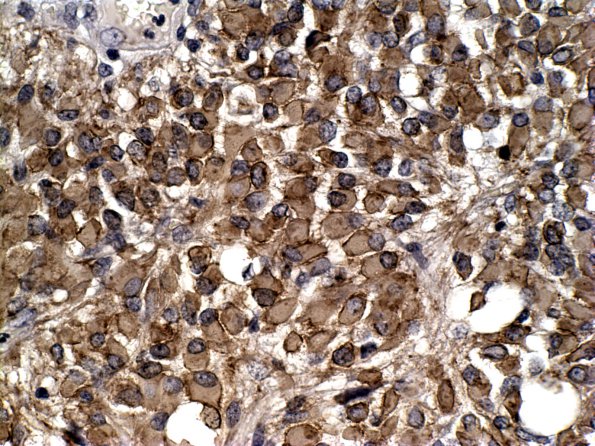 14B Oligodendroglioma, mini-gemistocytes (Case 14B)