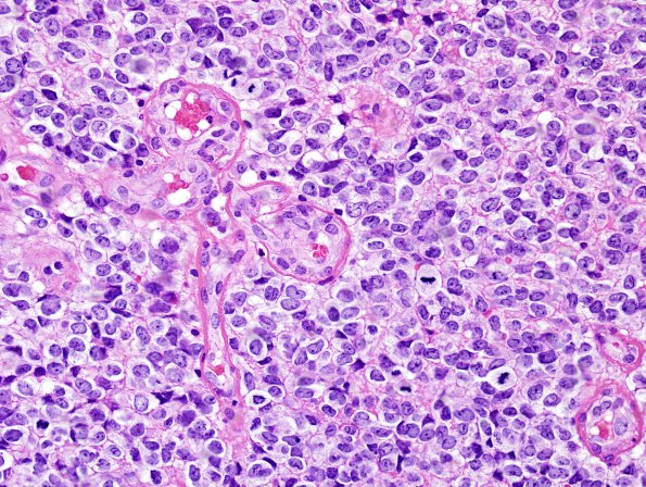 14C Oligodendroglioma, anaplastic (Case 14C) H&E 4